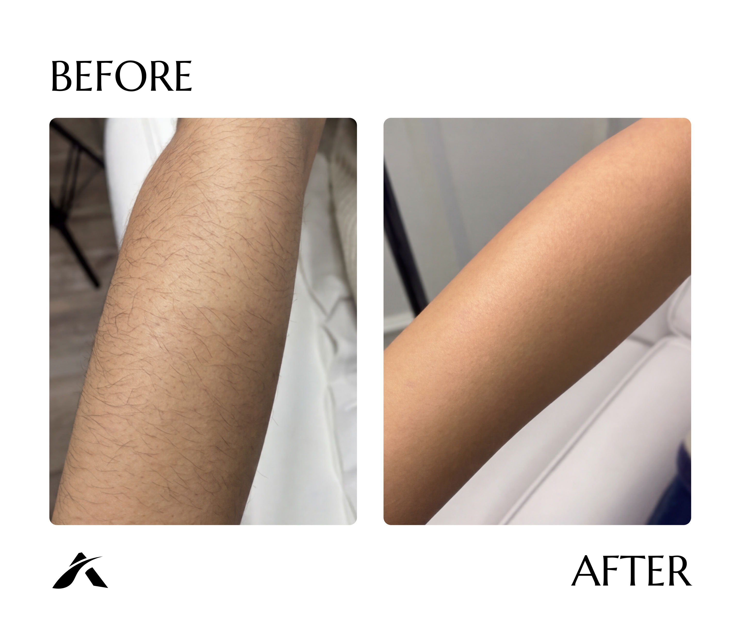 Arm laser hair removal — before and after six sessions with AI Tetra Freeze