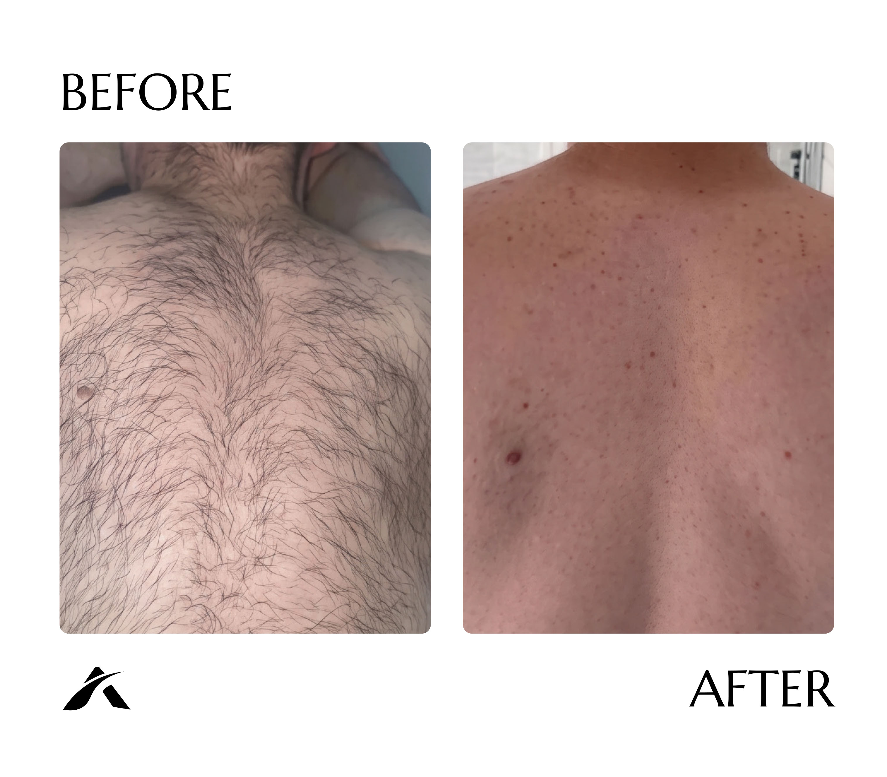 Back laser hair removal — before and after six sessions with AI Tetra Freeze