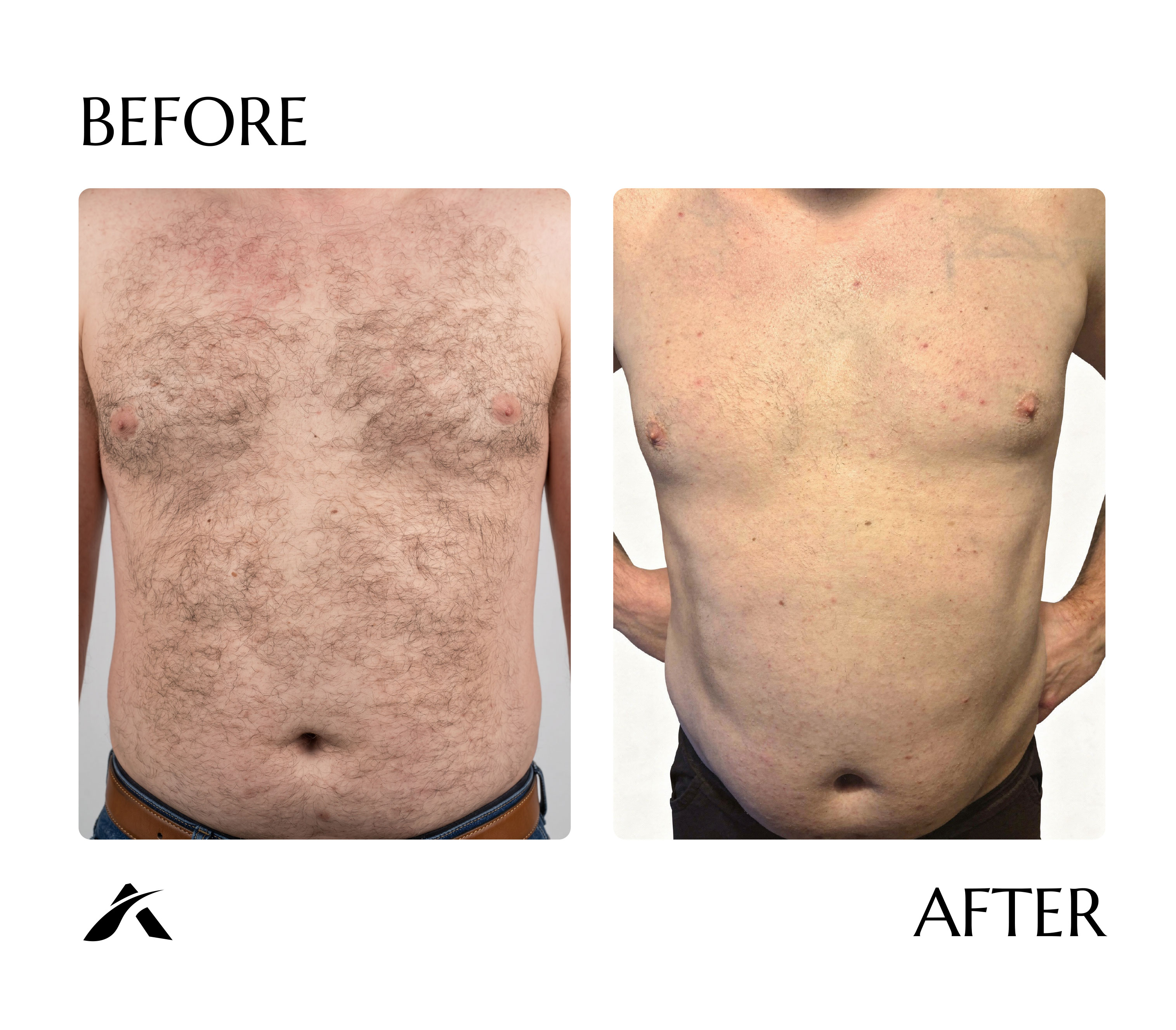 Chest laser hair removal — before and after five sessions with AI Tetra Freeze