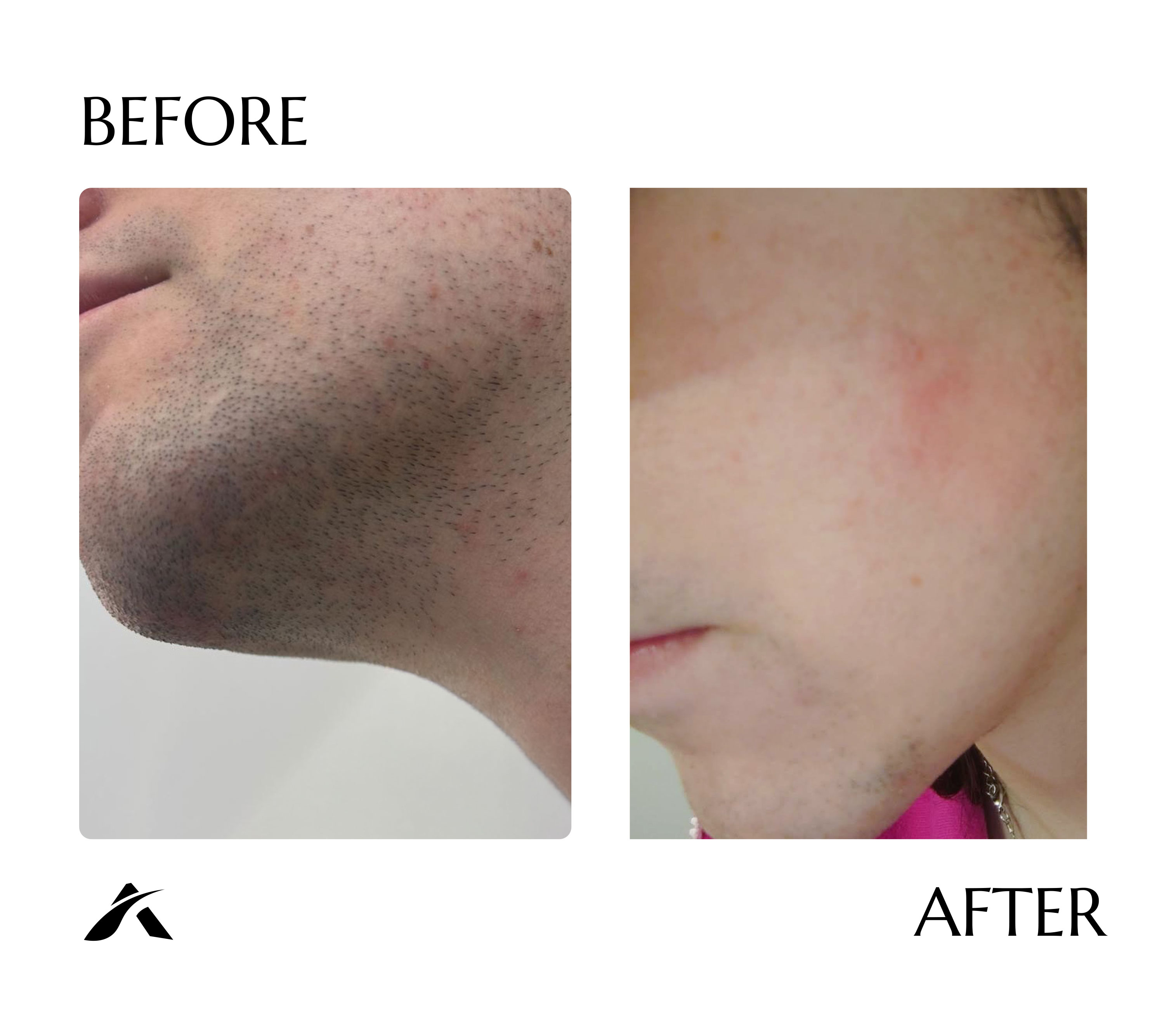 Face laser hair removal — before and after four sessions with AI Tetra Freeze