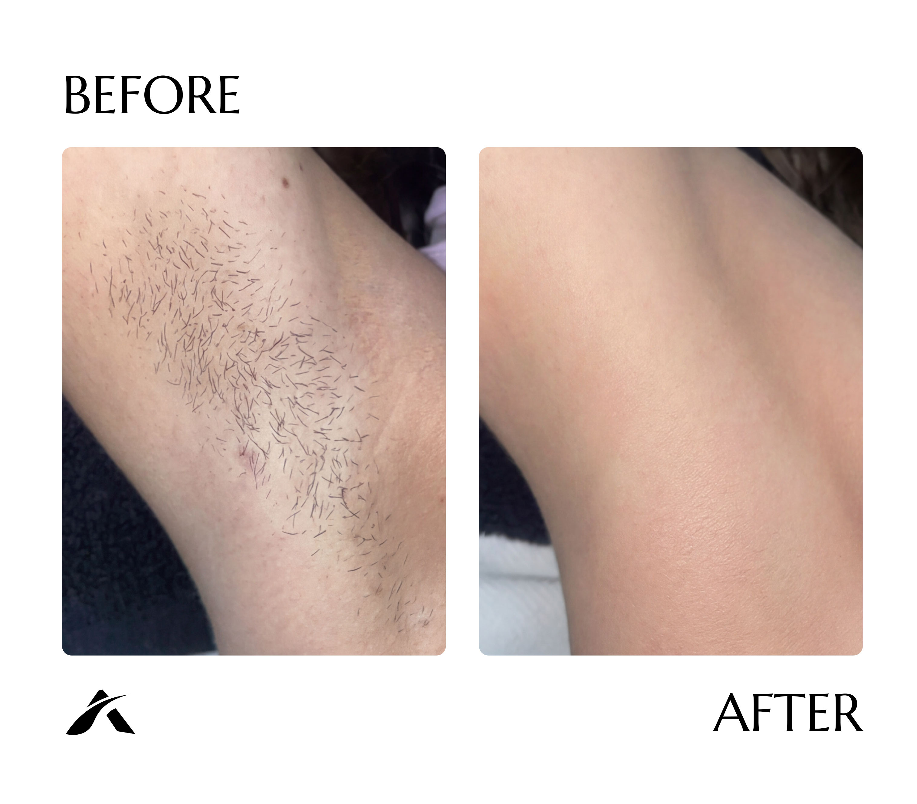 Underarm laser hair removal — before and after six sessions with AI Tetra Freeze